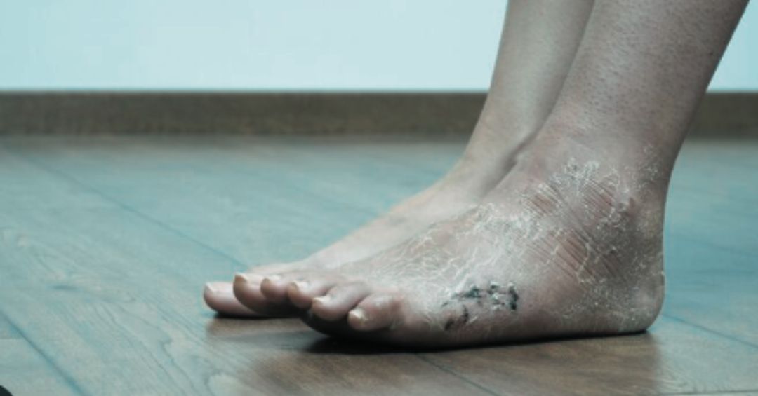 Especialistas alertan incremento de pie diabético en República Dominicana