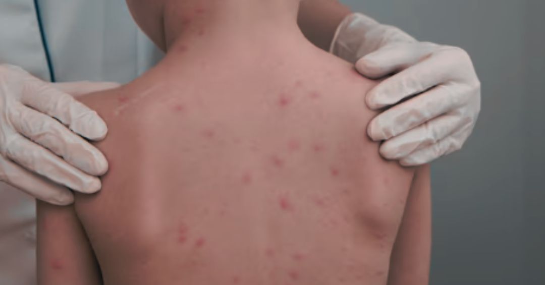 Varicela afecta a cualquier edad y es altamente contagiosa